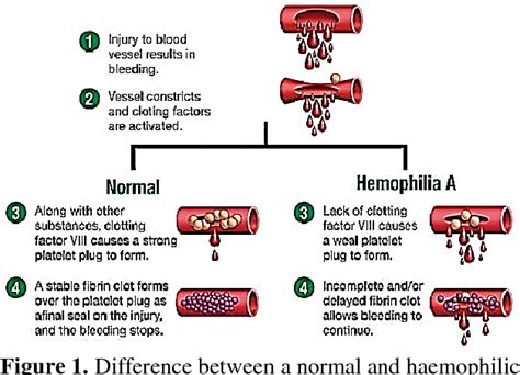 Figure 4 from Treatment of Haemophilia A by Replacement Therapy using ...