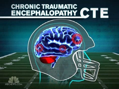 Sports Biz U: Will the NFL Fight against CTE?