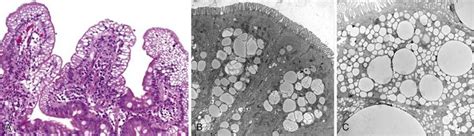 abetalipoproteinemia | Medical pictures, Picture, Medical