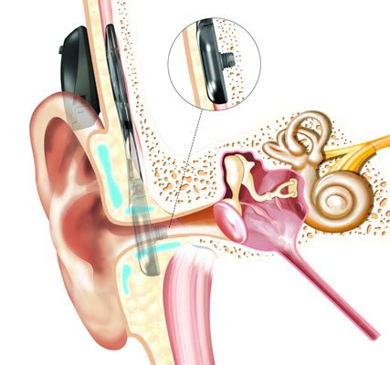 Bone Anchored Hearing Devices (BAHD) | Presbyterian Ear Institute