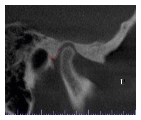 Example of three types of petrotympanic fissure positioning: (a) low-L,... | Download Scientific ...