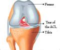 Knee Pain - Symptom Evaluation - Causes - FAQs