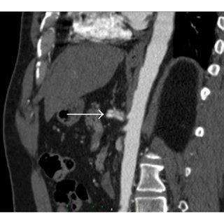 Control CT scan after one month. (a) Sagittal contrast-enhanced CT scan... | Download Scientific ...