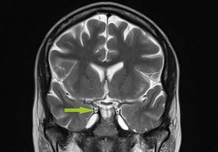 Oculomotor Nerve Wikipedia