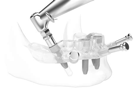 Surgical Guide - CT Dent