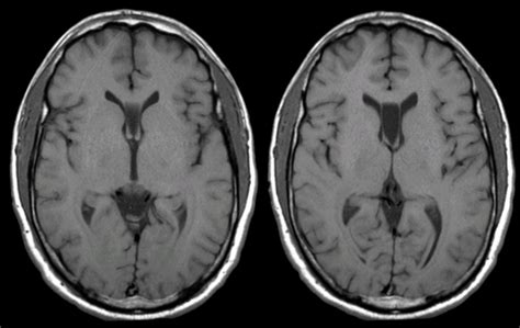 A 35 year-old woman underwent an MRI scan as part of a headache ...