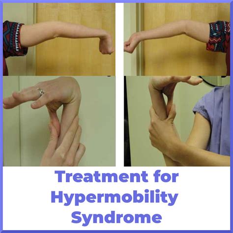 Joint Hypermobility Syndrome Tips - Sports Medicine Review