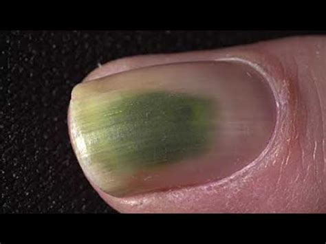 Green Fungus Between Toes : Athletes Foot, Ringworm Between the Stock ...