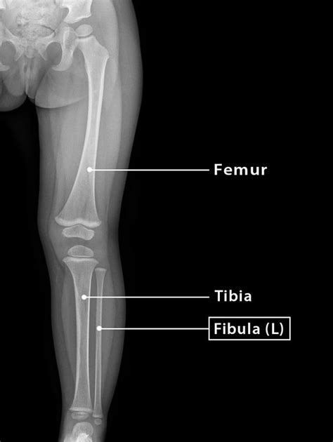 Fibula: Definition, Location, Anatomy, Functions, & Diagrams