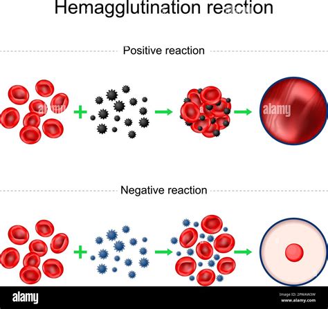 Hemagglutination reaction. Blood typing. Negative and Positive reaction. Agglutination test ...