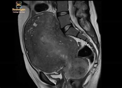 Adenomyosis – Radiology features and differtial diagnosis - RadioGyan