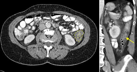 Acute diverticulitis - CT - Radiology at St. Vincent's University Hospital