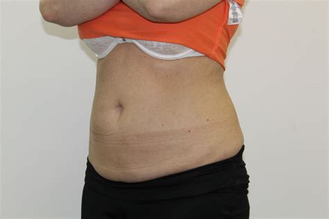 Cryolipolysis - Non-Invasive Body Contouring | ICE AESTHETIC