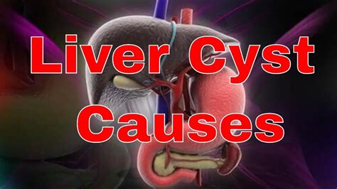 Causes of Liver Cysts (con imágenes)