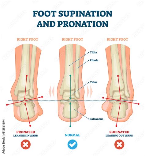 Foot supination and pronation vector illustration. Labeled medical scheme. Stock Vector | Adobe ...