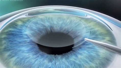 Vision Quest: LASIK, SMILE, and the Pioneering Path of SILK - Conlon Eye Institute