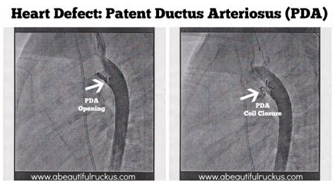 A Beautiful Ruckus: Caleb's Heart Surgery on His Patent Ductus Arteriosus (PDA)