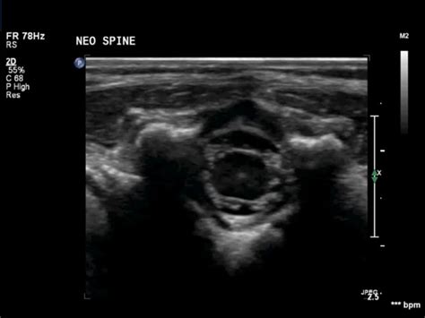 Neonatal Spine Normal – ULTRASOUNDPAEDIA