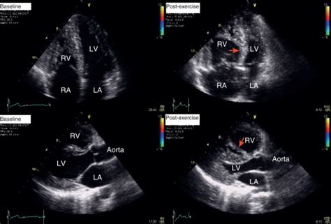 Stress Echocardiography | Thoracic Key