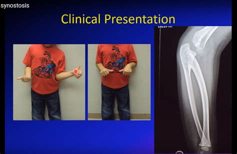 Congenital RadioUlnar Synostosis — OrthopaedicPrinciples.com