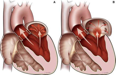 Severe mitral regurgitation: does one size fit all? | Heart