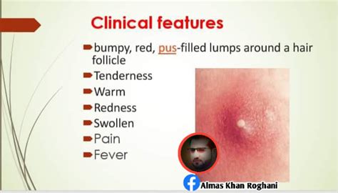 Boil / furuncle Causes Symptoms... - Almas Khan Roghani