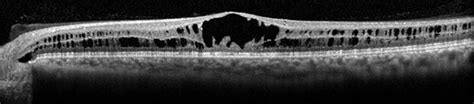 Myopic Degeneration - Vitreous Retina Macula Consultants of New York