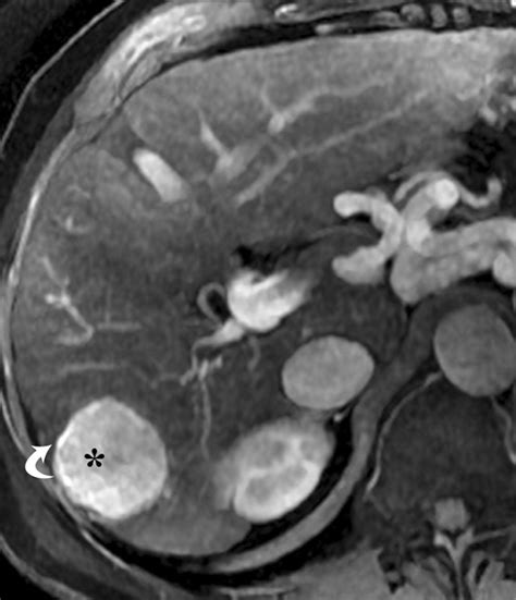 MR Imaging of Liver Fibrosis: Current State of the Art | RadioGraphics