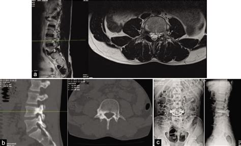 Osteoid Osteoma Mri Spine