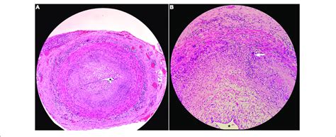 | Histopathology of superficial temporal artery biopsy showing (A ...