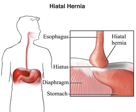 Hiatal Hernia Treatment in New Jersey | Thoracic Care