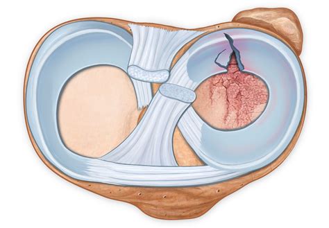 Meniscus Repair Surgery for Torn Knee Cartilage