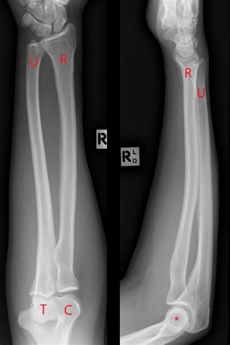 Midshaft radius and ulna fractures - Don't Forget the Bubbles