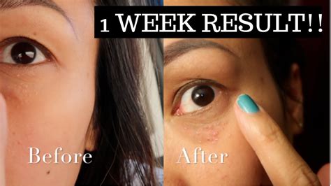 REMOVING MY UNDER EYE MILIA !! | BEFORE & AFTER RESULTS !!!! | 1 WEEK RESULT - YouTube