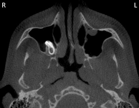 Case of the week: Third Molar in Maxillary Sinus – Dr. G's Toothpix