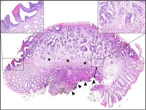 Adenomatous Polyp Histology