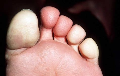 Raynaud's Disease - Causes, Symptoms, Treatment