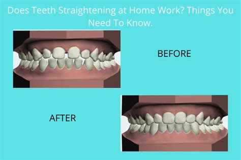 Does Teeth Straightening at Home Work? Things You Need To Know | AlignerCo