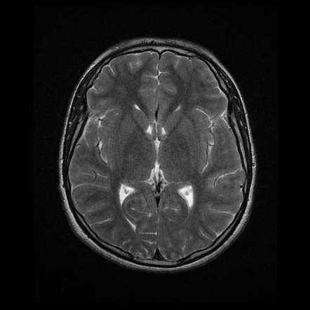 Choroidal fissure cyst | Radiology Case | Radiopaedia.org