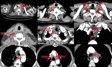 Cervical Lymph Nodes Ct | My XXX Hot Girl