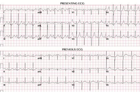 Hyperkalemia With Peaked T Waves On Ecg These Are | Free Nude Porn Photos