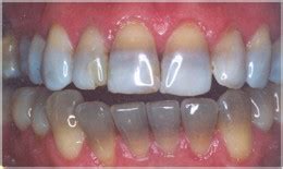 Tetracycline Tooth Staining: Its Cause, Prevention & Treatment | Oral Answers