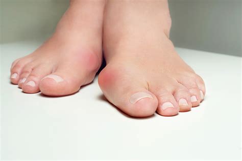 Bunion Problems - American Foot & Leg Specialists