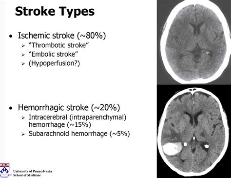 Ischemic Vs Hemorrhagic Stroke Mri