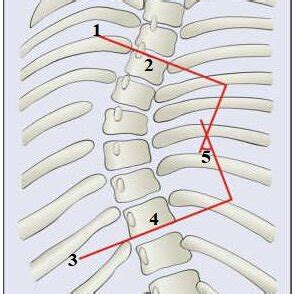 A schematic view of the spine showing how Cobb angle is measured (26)... | Download Scientific ...