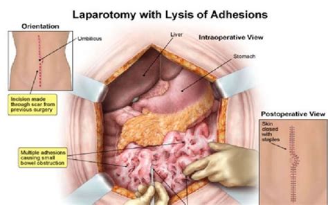 Lysis Of Abdominal Adhesions Symptoms, Intestinal, Uterine, Like Categories Define | Abdominal ...