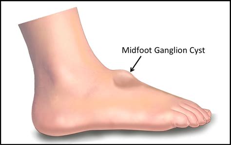 Ganglion Cysts - FootEducation