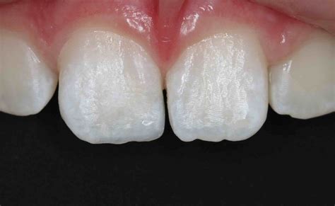 White Fillings Before and After photos - Front Tooth Composite Fillings