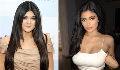 Kylie Jenner After & Before Pictures: Did She Do Surgery? - Demotix.com