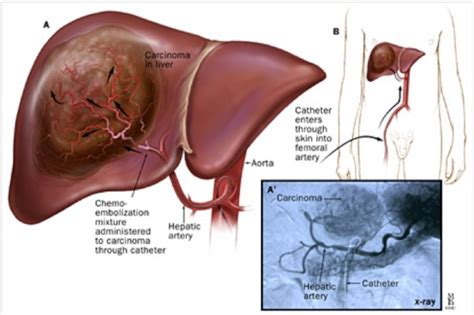 Liver Tumors using TACE | ERA Billings